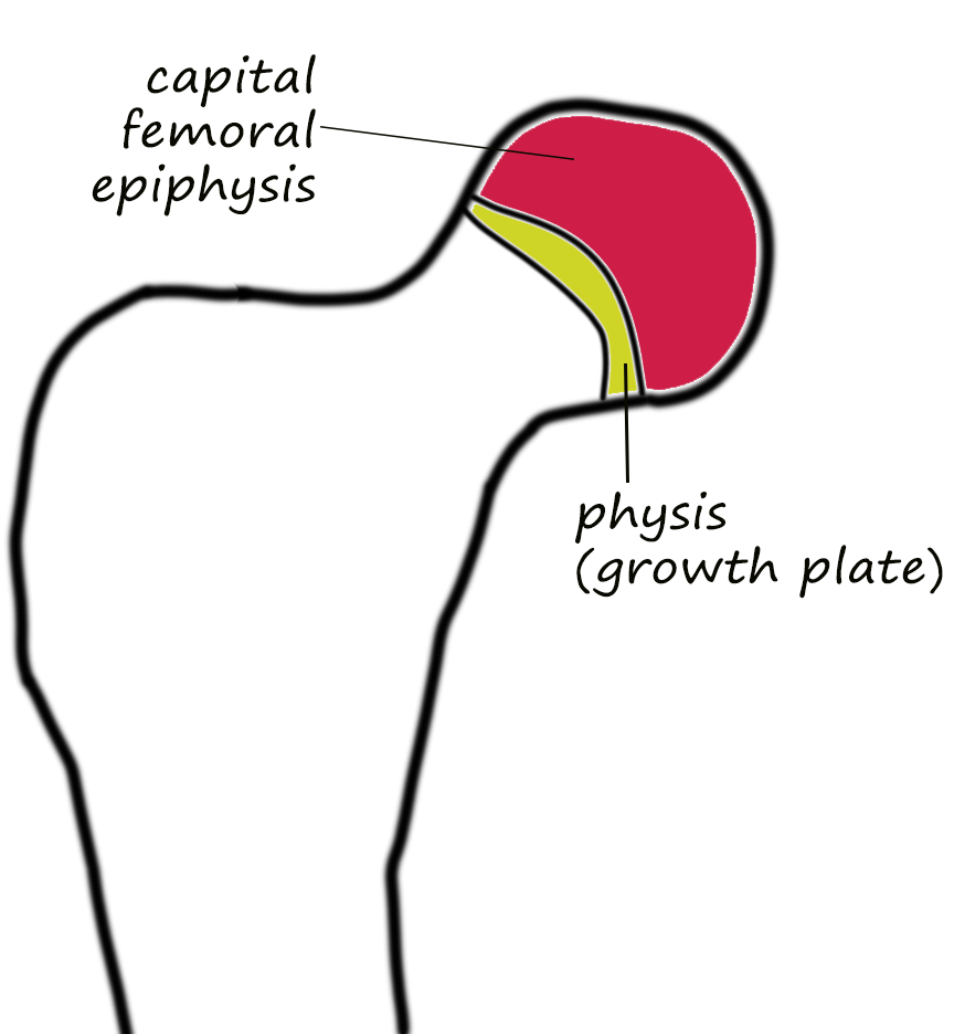 Line drawing of the top of a femur bone, with the bulbous epiphysis labeled, along with the physis growth plate below it.